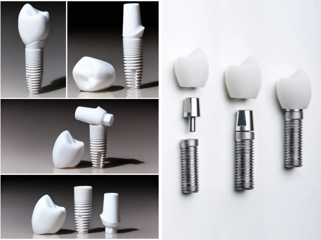 Dental Implants zirconia vs. Titanium: Choosing the Best Option for You