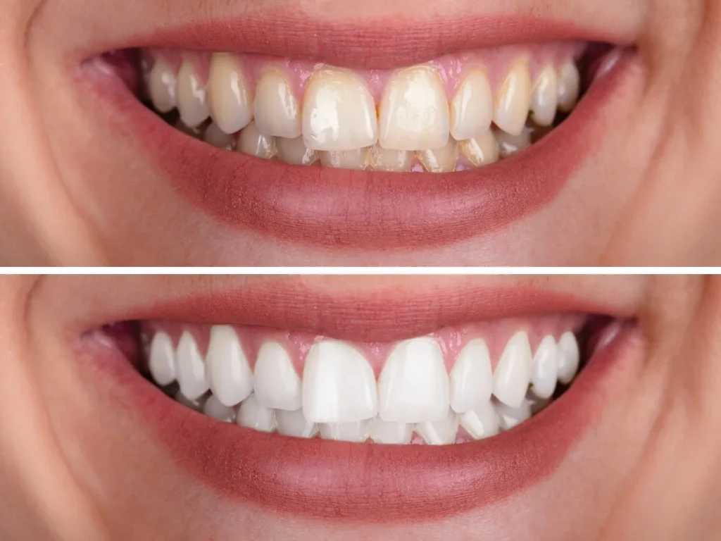 dental before and after